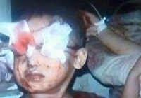 عکس/ سعودی‌ها چشم کودک یمنی را گرفتند