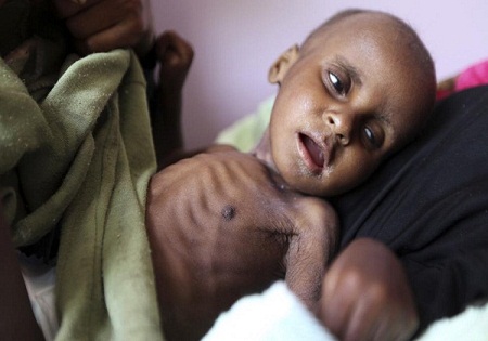 تصاویری دلخراش از کودکان گرسنه یمنی